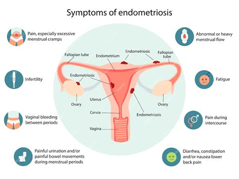 Infographie des symptômes de l'endométriose Vecteur détaillé Infographie Santé des femmes ...