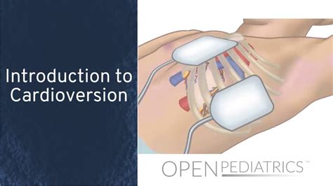 Image result for Cardioversion Steps