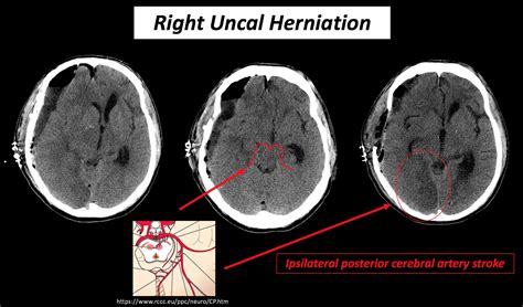 Hernia Uncal RARE CASE; Brain Herniation : R/AskDocs