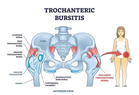 Outer Hip Pain Explained: Greater Trochanteric Pain Syndrome
