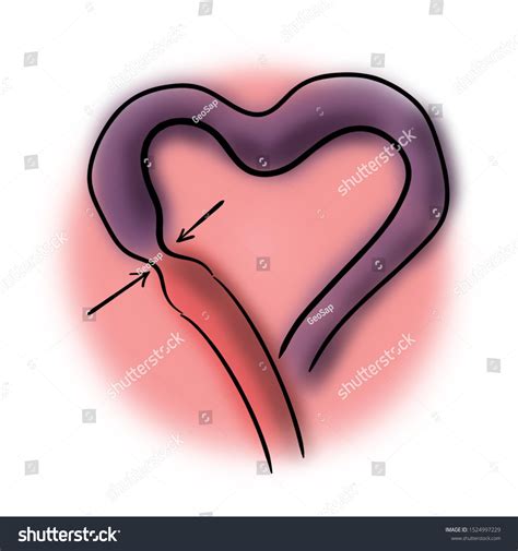 Heart Coronary Artery Spasm Stock Illustration 1524997229 | Shutterstock