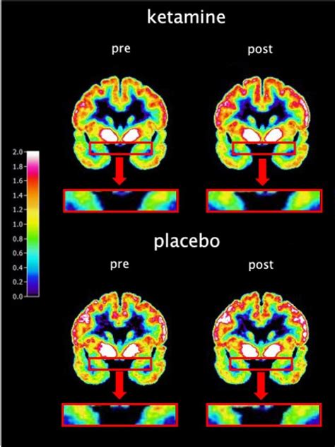 How ketamine therapy works with neuroplasticity 