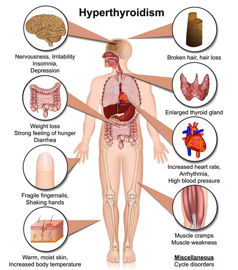 Why Weight Gain In Hyperthyroidism at Dale Duffin blog