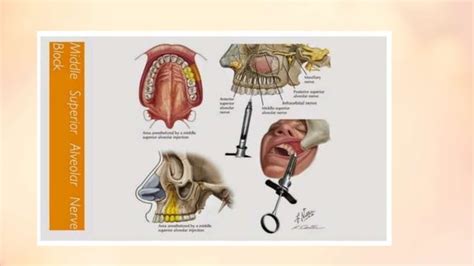 Extraoral Technique of Local Anesthesia 的图像结果