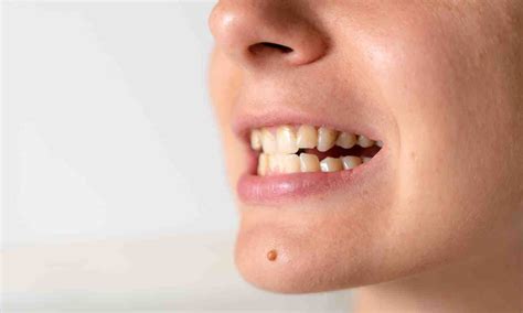 Long term Profile attractiveness similar in extraction and ...