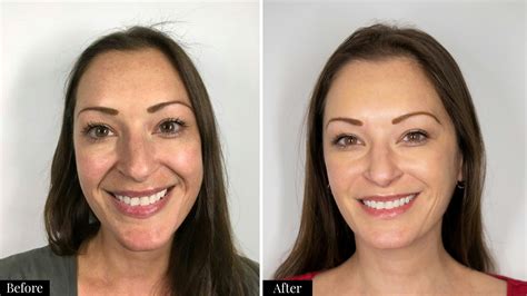 Nasolabial Folds Dermal Filler Treatment M1 Med Beauty Australia - sincerelystacey.blog