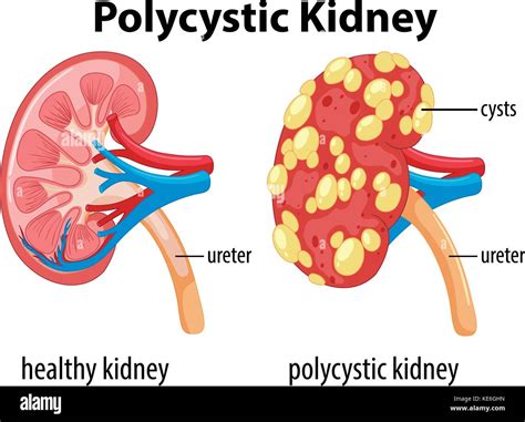 Polycystic Disease _ Polycystic Kidney Disease: Symptoms, Diagnosis, and Treatment – JCDAT