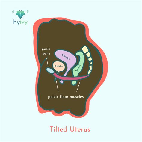 What Is A Tilt Uterus at Amy Jonsson blog