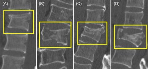 Types Of Vertebral Fractures : Types of Thoracic Vertebral Fractures Explained – NIIK