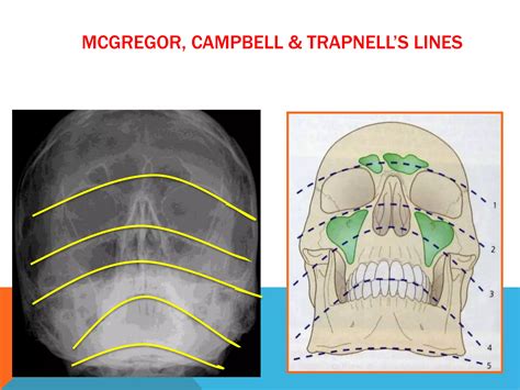 Management of zygomaticomaxillary complex fractures ih | PPTX