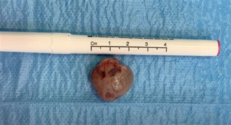 Image result for Abscessed Cysts Exploding