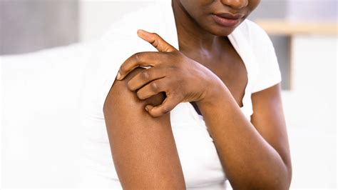 Nemluvio (Nemolizumab) FDA Approved for Prurigo Nodularis in Adults - GoodRx