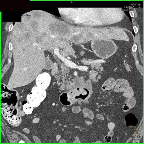 Pancreatic Cancer with Liver Metastases - Pancreas Case Studies - CTisus CT Scanning