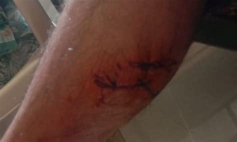 Theni Periyakulam road rabies bite 6 injured | தேனி பெரியகுளம் சாலையில் ...