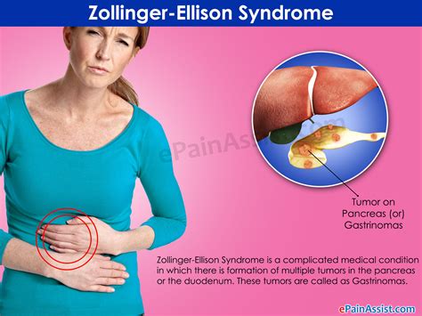 Zollinger-Ellison Syndrome: Treatment, Prognosis, Life Expectancy