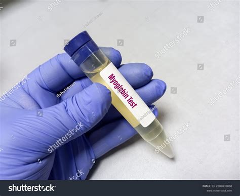 22 Myoglobin Urine Royalty-Free Images, Stock Photos & Pictures ...