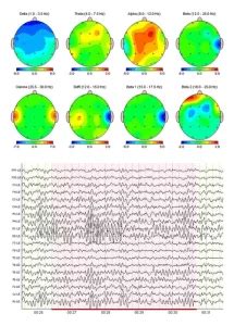 Image result for MATLAB Qeeg Brain Map