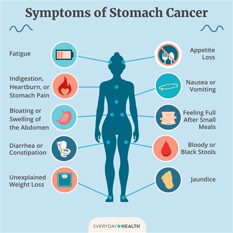 Esophageal Cancer: Symptoms, Causes, Diagnosis, Treatment, and Prevention