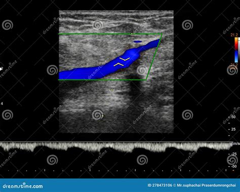 Color Doppler Ultrasound Determination in Deep Vein Thrombosis Patients for Finding Deep Vein ...