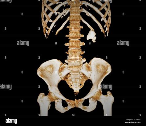 Kidney stone, 3D CT scan Stock Photo - Alamy