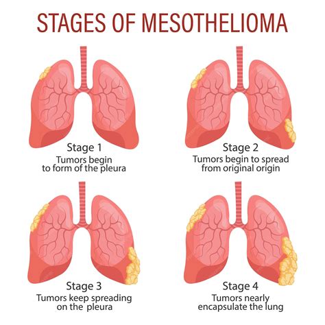 Stages of mesothelioma lung disease healthcare medical infographic ...