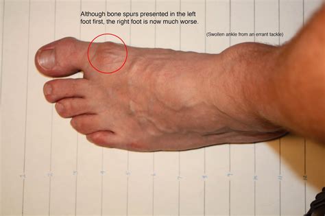 Soccer After 40: Removing my bone spurs