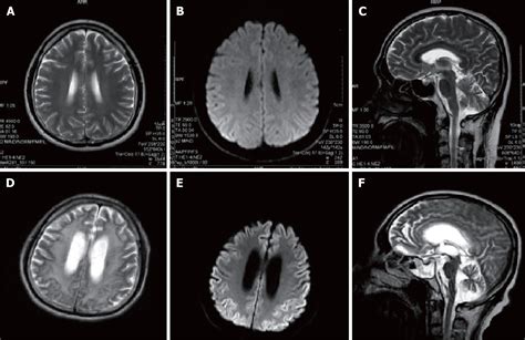 Gerstmann-Sträussler-Scheinker disease: A case report