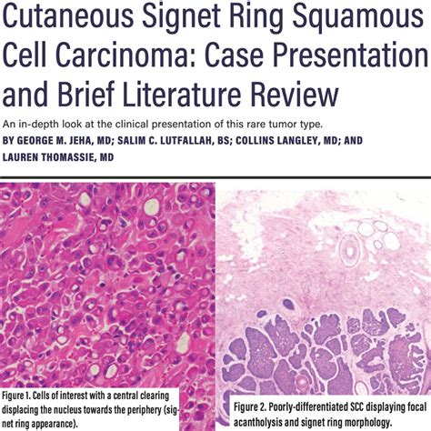 Signet ring type cutaneous squamous cell carcinoma (cSCC) is an extremely rare variant, with ...