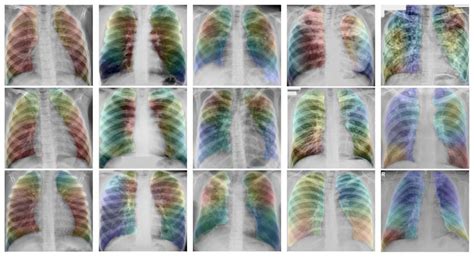 Drug-Resistant Tuberculosis Treatment Recommendation, and Multi-Class Tuberculosis Detection and ...
