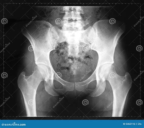 X-ray of the pelvis stock photo. Image of details, hips - 5463116