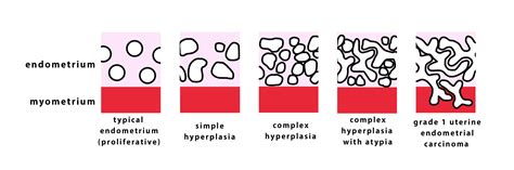 Image result for Hyperplastic Endometrium