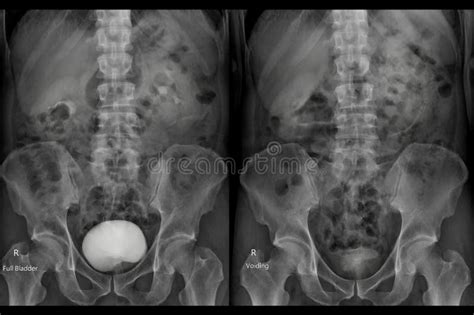 Image result for Contrast Pyelogram