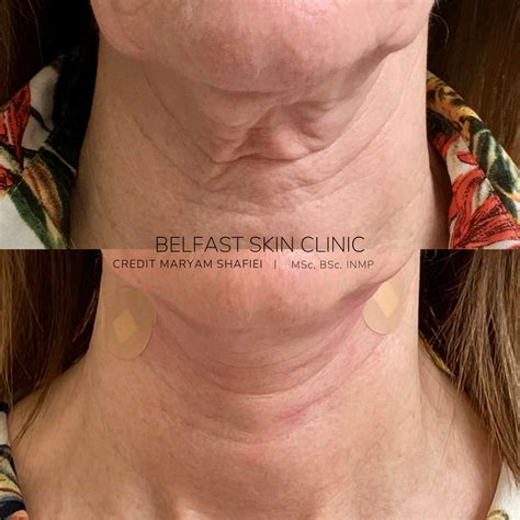 Image result for Thread Lifting Face