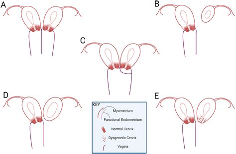 Presentation and Management of Uterine Didelphys with Unilateral Cervicovaginal Agenesis ...