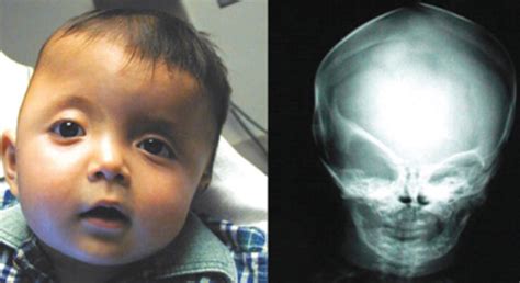 Flat Head Syndrome - Medical Grade Baby Pillow - Flat Head | Mimos ...