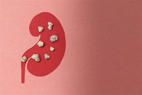 Here’s 5 Essential Facts You Need to Know About Kidney Stones | Femina.in