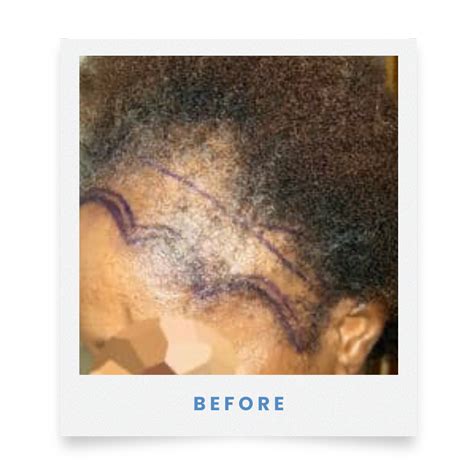 Traction Alopecia Surgery - Medical Hair Restoration