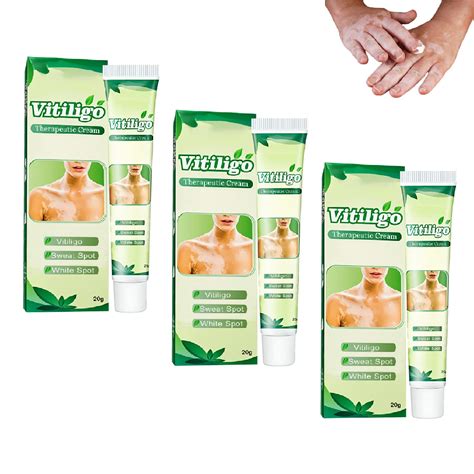 Buy SBZX Vitiligo Cream,White Tag Moisturizing Cream,Vitiligo ...