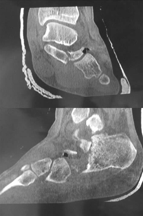 Vacuum phenomenon in a dislocated joint | BMJ Case Reports