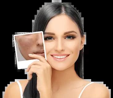Pigmentation Treatment in Ameerpet: Cost, Benefits and Procedure
