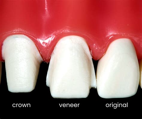 Dental Crown And Veneer at Anna Kowalski blog