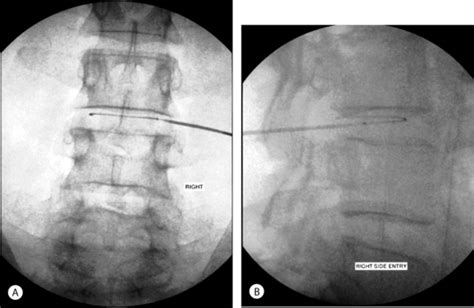 Image result for Idet Disc Procedure