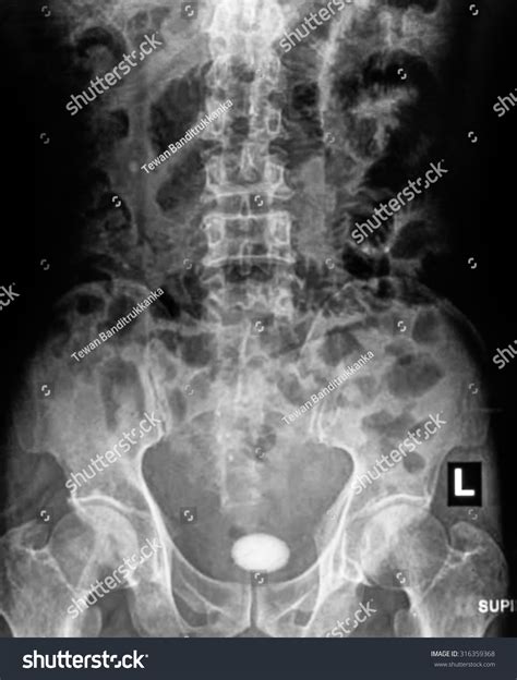 Xray Image Plan Kub Kidneyureter Bladder Stock Photo 316359368 ...