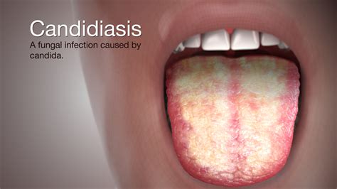 Penyakit Candidiasis - Perumperindo.co.id