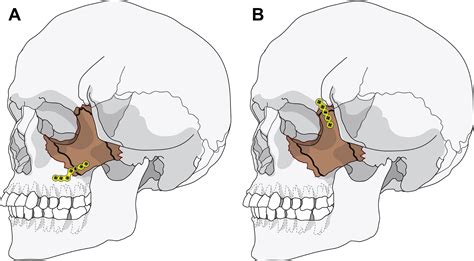 Fracture Zygomaticomaxillary Complex