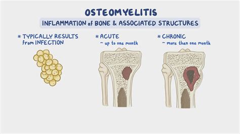 Video: Osteomyelitis: Nursing | Osmosis
