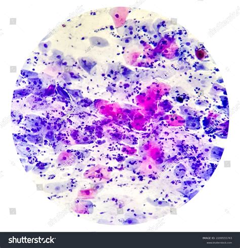 Microscopic View Paps Smear Showing Severe Stock Photo 2209555743 | Shutterstock