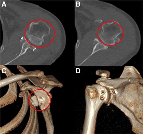 All-Arthroscopic Treatment of Combined Off-Track Hill-Sachs Lesions Using Interference Screw and ...