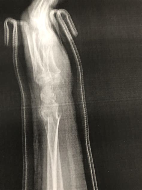 Image result for Fractured Radius