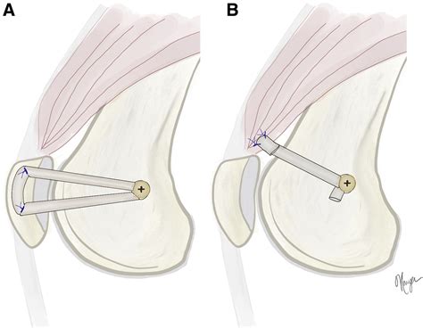 Medial Patellofemoral Ligament